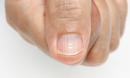 ​指甲保养也是一门学问 如何处理指甲表面不光滑的情况